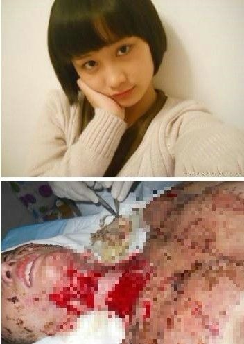 周岩被烧伤前后对比