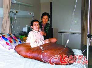 越南男子手术摘90公斤重巨瘤